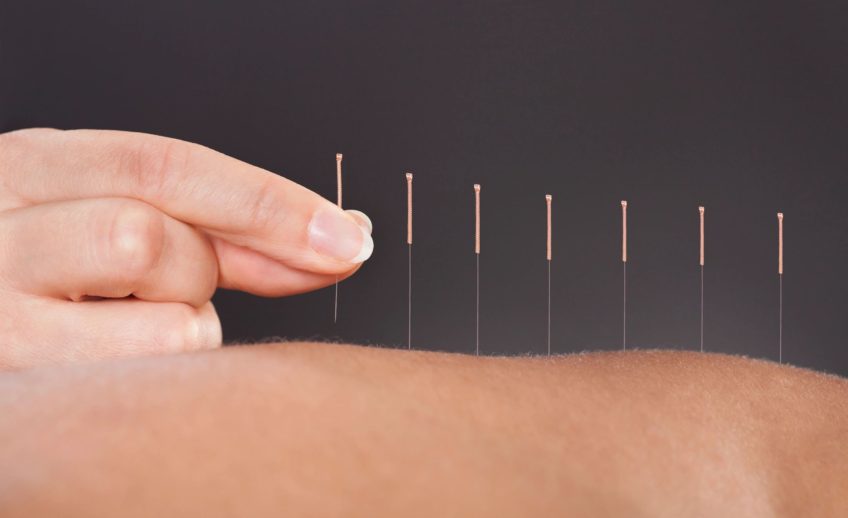 Acupuncture